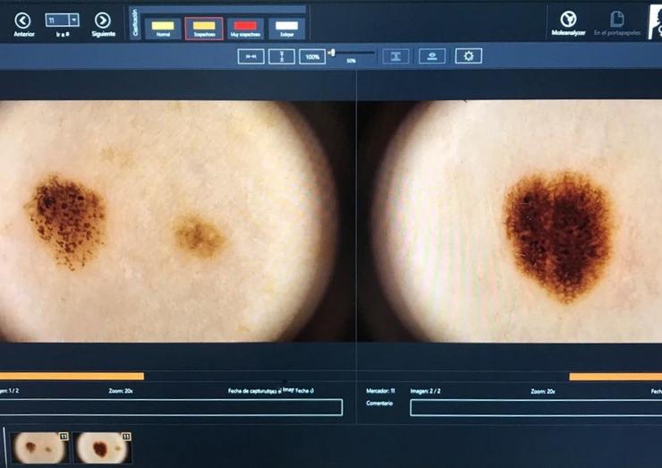 Dermatoscopia dixital na procura de melanomas ou cancros na pel 